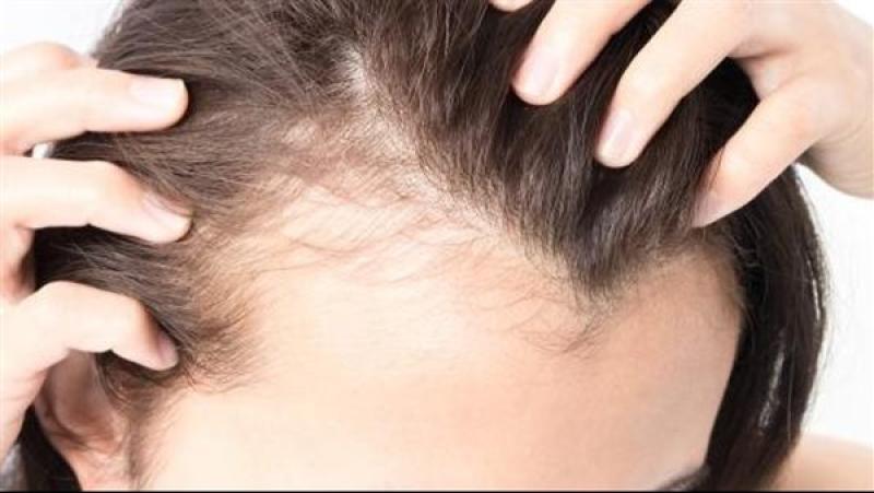 خبيرة تجميل تقدم وصفة طبيعية لتكثيف الشعر الخفيف وعلاج فراغات الشعر